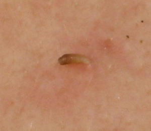 Removed blackhead on the face